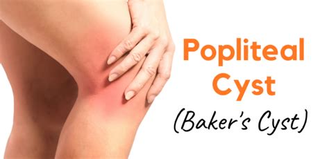 Popliteal Cyst