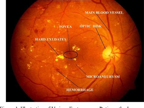 A Novel Approach for Detection of Microaneurysms in Diabetic Retinopathy Disease from Retinal ...