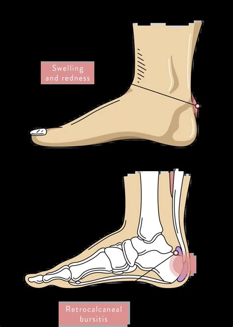 Heel Pain | Causes, Types and Podiatry Treatment