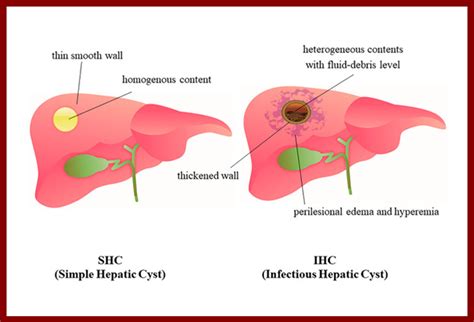 homeopathic treatment for Hepatic cysts in homeopathy, Hepatic cysts ...