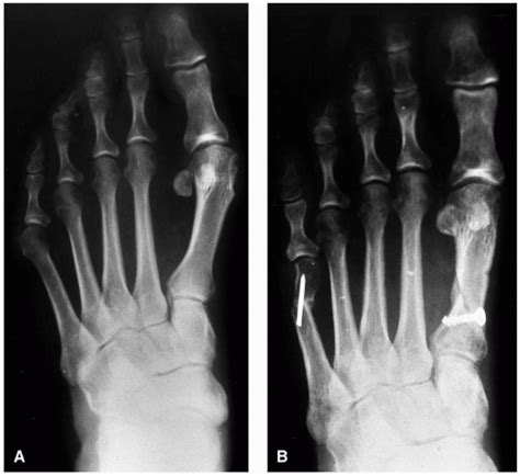 Proximal Procedures of the First Ray | Musculoskeletal Key