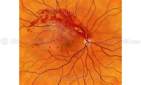 Branch retinal vein occlusion BRVO - #CO0095 | Stock eye images