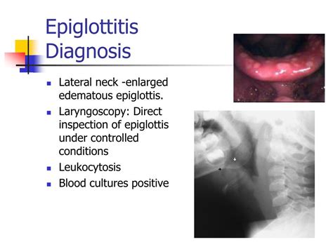 Epiglottitis Ct Scan