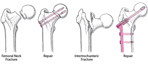 Hip Fractures - Injuries; Poisoning - MSD Manual Professional Edition