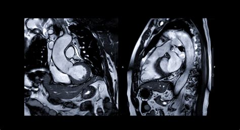 Cardiac MRI - Lakeland, Florida - Radiology and Imaging Specialists