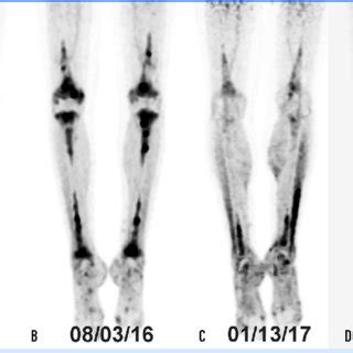 The FDG-PET scan demonstrates a symmetrical radiotracer uptake in the... | Download Scientific ...