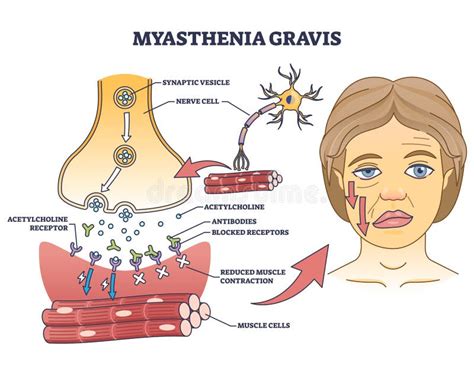 Myasthenia Gravis Symptoms Stock Illustrations – 8 Myasthenia Gravis Symptoms Stock ...