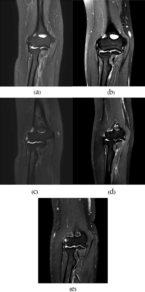 MRI illustration for the degree of common extensor tendon injuries. The ...