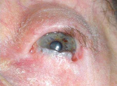 Ocular Cicatricial Pemphigoid: Causes, Diagnosis, Treatment Options