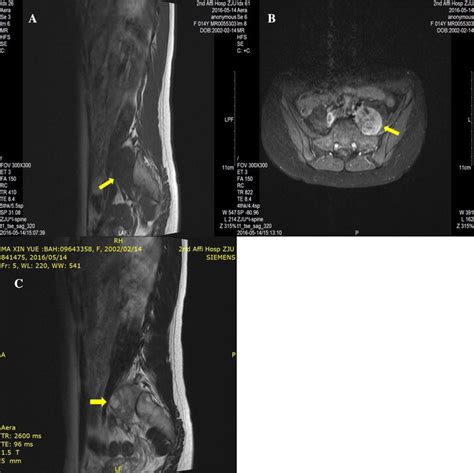 Malignant peripheral nerve sheath tumor in the paraspinal region mimicking a benign peripheral ...