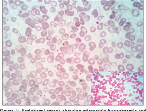 Figure 1 from Phenotypic heterogeneity of delta–beta thalassemia ...