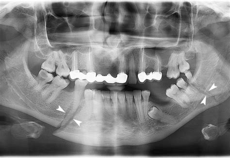 Mandibular Fracture X Ray