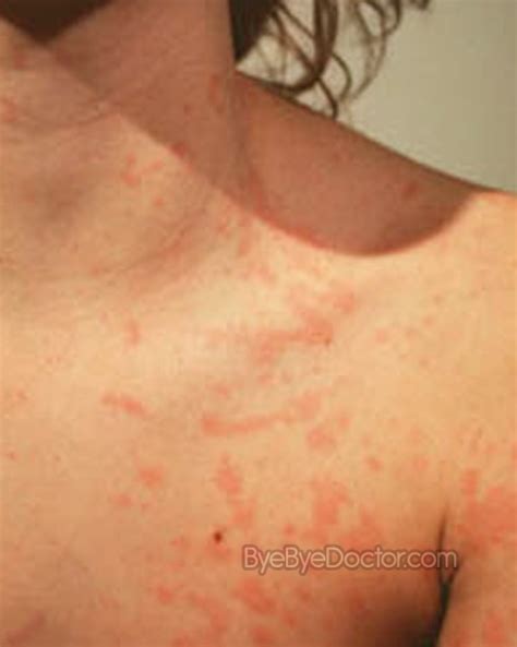 Swollen Lymph Nodes – Symptoms, Causes, Diagnosis, Treatment, Pictures