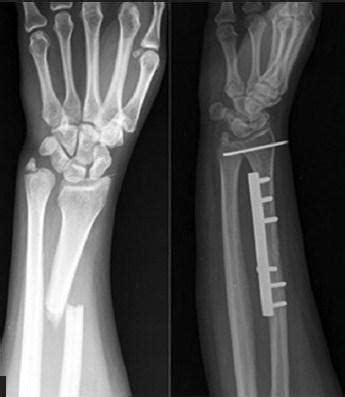 Galeazzi Fractures - Trauma - Orthobullets