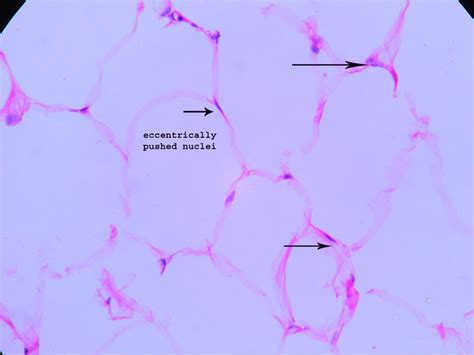 Lipoma – Histopathology.guru