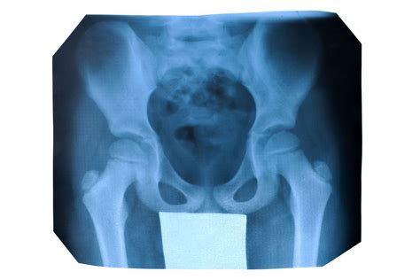 New Zimmer Hip Implant Lawsuit Alleges Serious Injuries, Failure to Warn - Top Class Actions