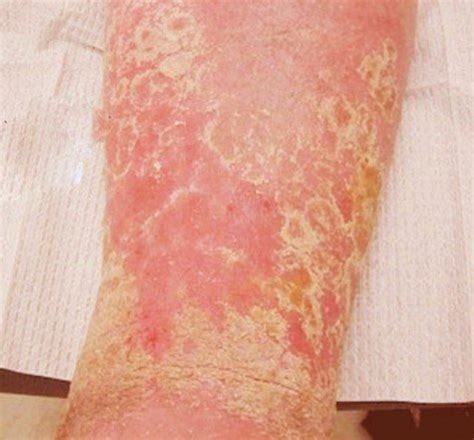 Stasis Dermatitis - Pictures, Symptoms, Causes, Treatment, Diagnosis - HubPages