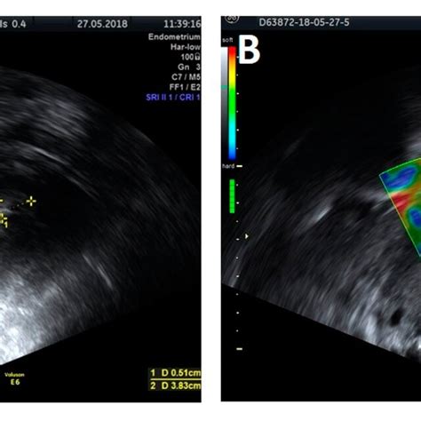 Comparison of endometrial thickness (ET) in ultrasound examination and ...