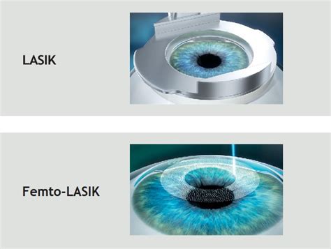 What you should know about LASIK Vs Femto-LASIK - Eye Consultants