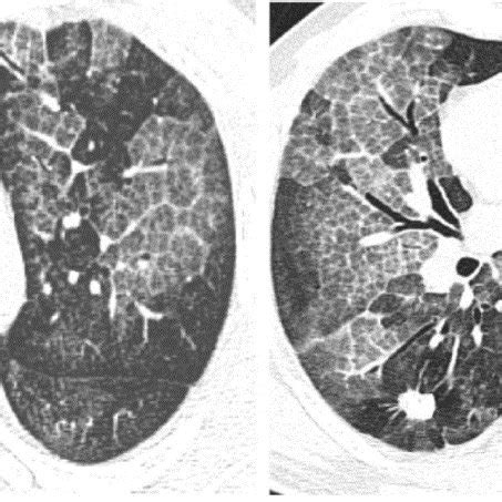 Chest computed tomography scan showing bilateral crazy paving pattern... | Download Scientific ...