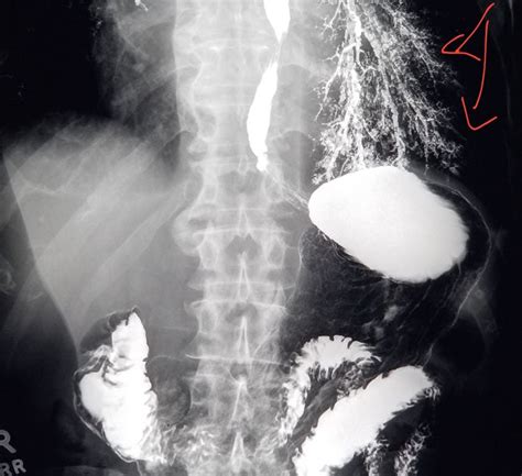 #Xray from #barium study shows #aspirated #contrast in the #lung. #radiology #radiologist # ...