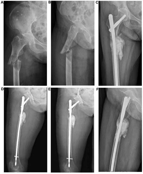 Intramedullary Nailing Femur Recovery - Nail Ftempo