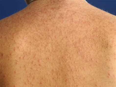 pseudomonas folliculitis - pictures, photos