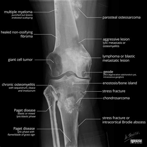 Can Bone Tumors In Dogs Be Benign