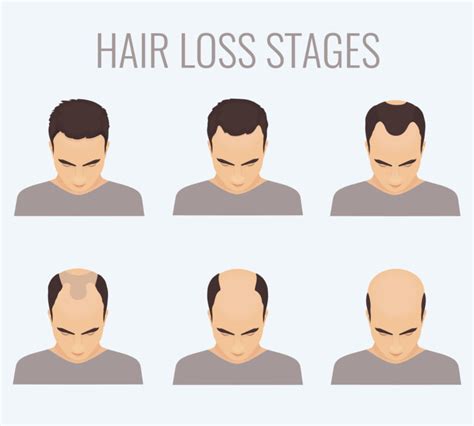 Woman with different stages of hair loss | Vegas Valley Hair Restoration