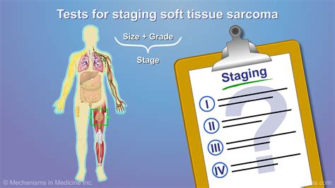 Diagnosing and Treating Soft Tissue Sarcoma