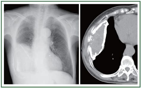 Pleurisy In Chest X-Ray: Various Radiographs To Show And Depict This ...