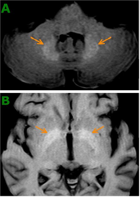 High signal intensity in dentate nucleus and globus pallidus on ...