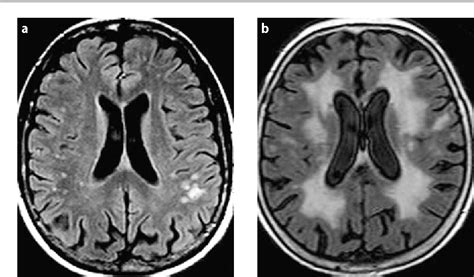 Sub Cortical White Matter - slideshare