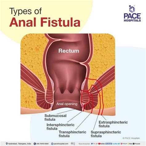 Anal Fistula Symptoms, Causes, Types, Complications,, 40% OFF