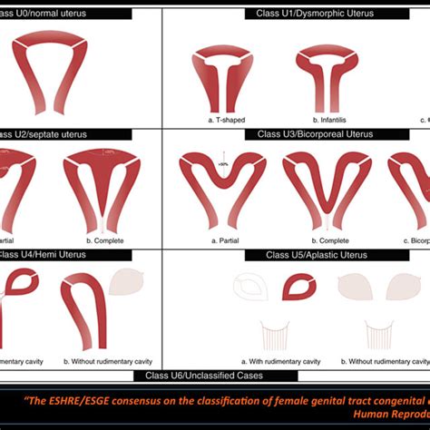 AFS Classification of Múllerian duct anomalies | Download Scientific Diagram