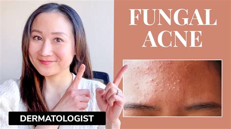 Dermatologist's Guide to FUNGAL ACNE | What is it? & Treatments - YouTube