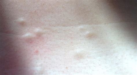 Small lumps under skin on chest - What are they? Can you please help ...