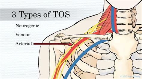 Thoracic Outlet Syndrome Diagnosis - slideshare