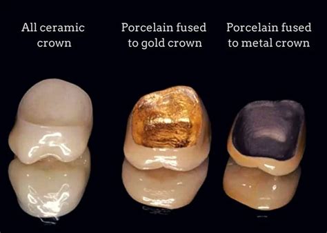 What is the Typical Cost of a Dental Crown?