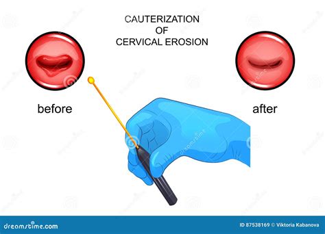 Cauterization of Erosion. before and after Stock Vector - Illustration of myoma, fibroid: 87538169