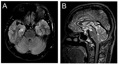 MRI scans of HE patients. (A and B) Patient No.4 with memory... | Download Scientific Diagram