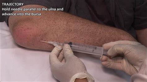 Olecranon Bursitis - Aspiration and Injection - In Vivo Series - YouTube