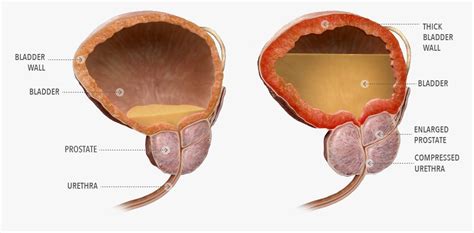 Should men with an enlarged prostate avoid certain medications? - Men's ...