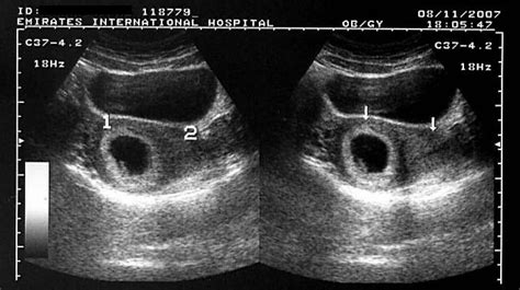 ON - RADIOLOGY: Ultrasound images of Bicornuate uterus with gestation sac