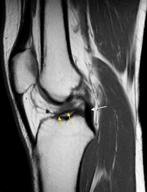 ACL tear - Radiology at St. Vincent's University Hospital