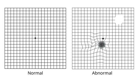 Amsler Grid Chart With Instruction