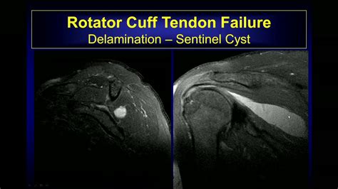 Imaging findings of Rotator cuff - YouTube