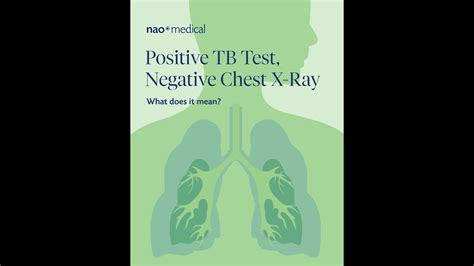 Positive TB Test, Negative Chest X-Ray: What Does It Mean? - YouTube