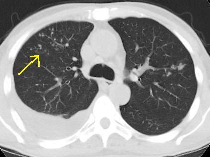 Tree-In-Bud Appearance-CT Sign - Sumer's Radiology Blog