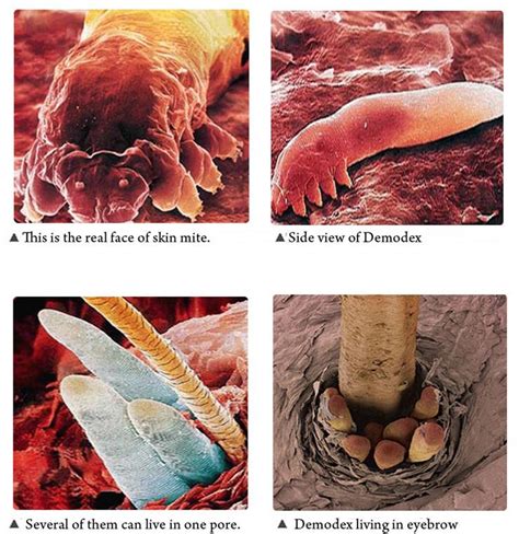 Face Mites Treatment - Doctor Heck